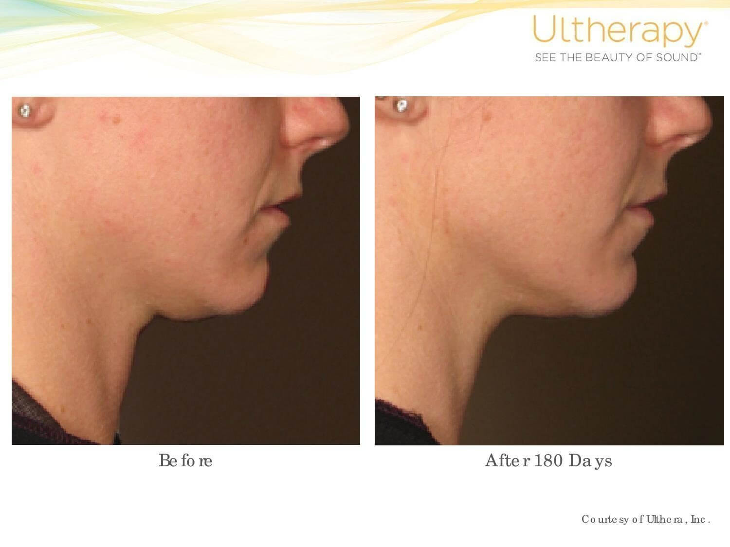 Ultherapy