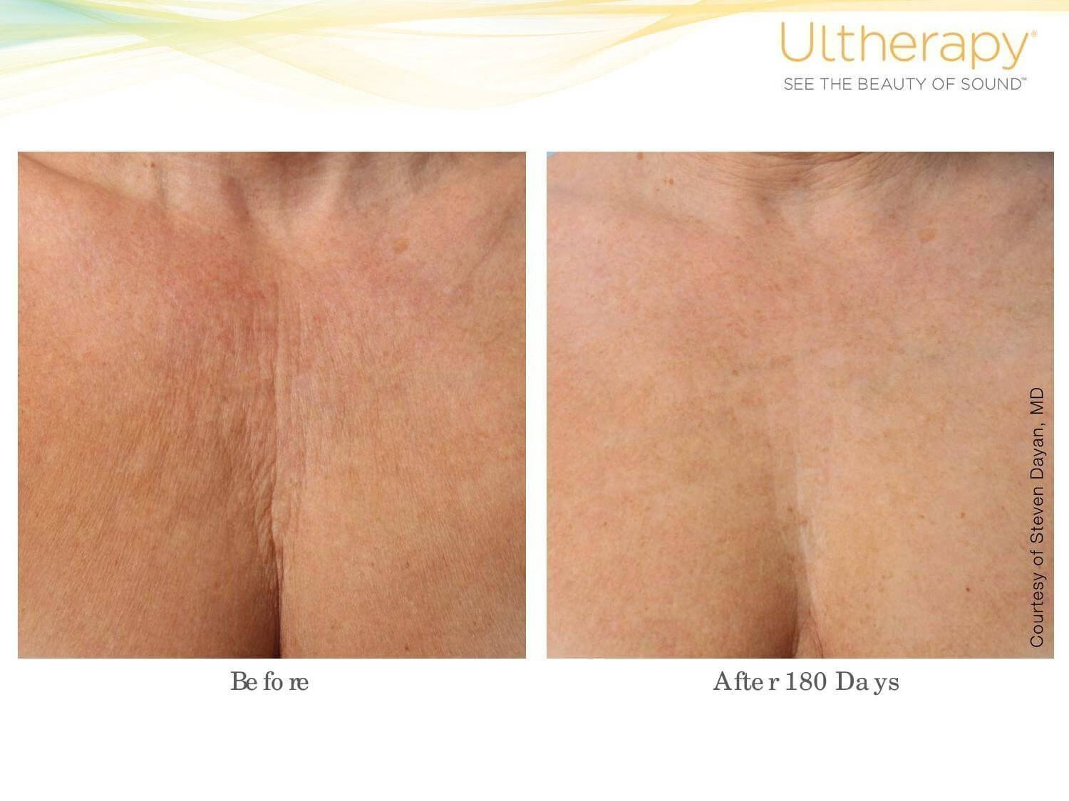 Ultherapy