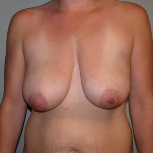 Woman standing front view showing sagging breast tissue before breast lift surgery