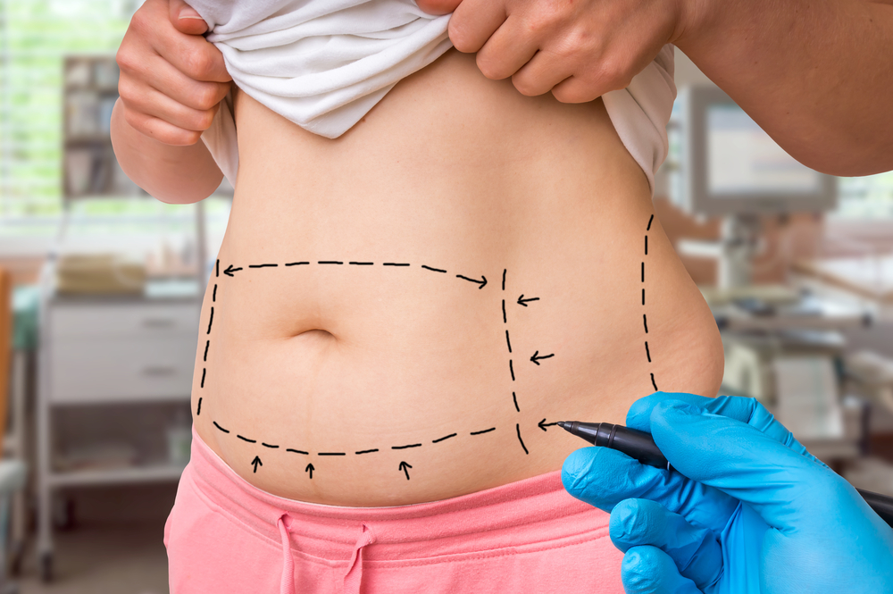 What Happens During a Tummy Tuck? - Tarola Plastic Surgery Nashville
